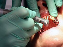 Implantate Zahn Zähne Zahnarzt Gesundheit